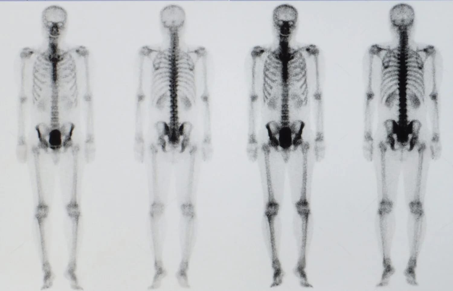 Advancements in Bone Cancer Treatment: A New Era of Hope