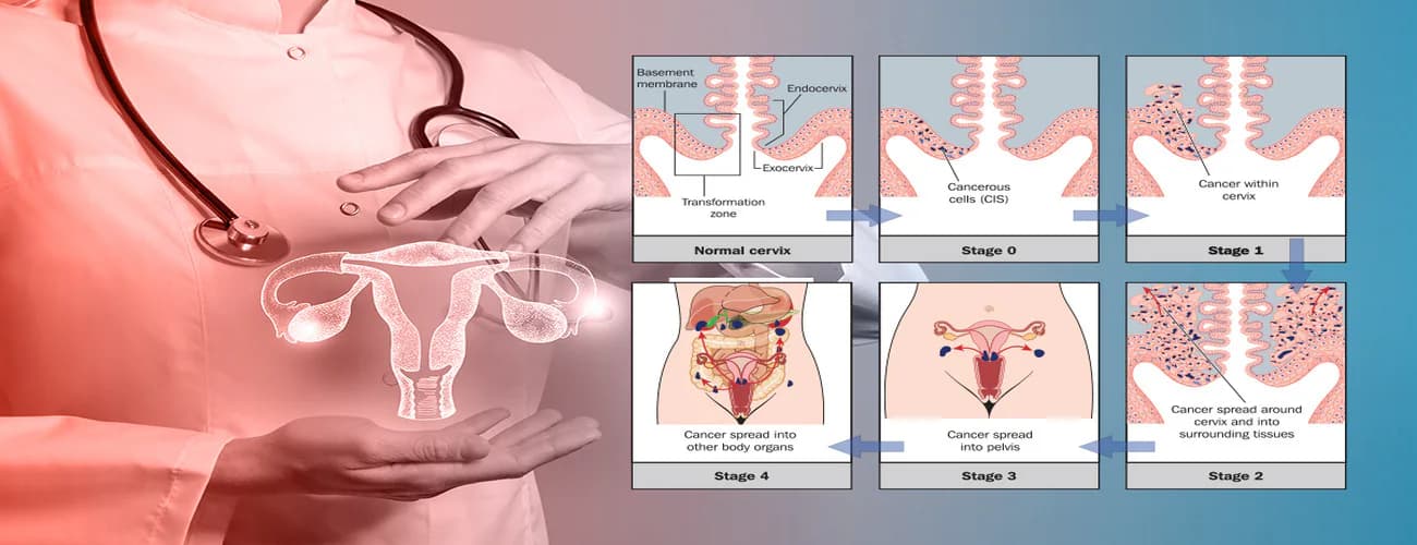 Navigating the Stages of Cervical Cancer: A Comprehensive Guide