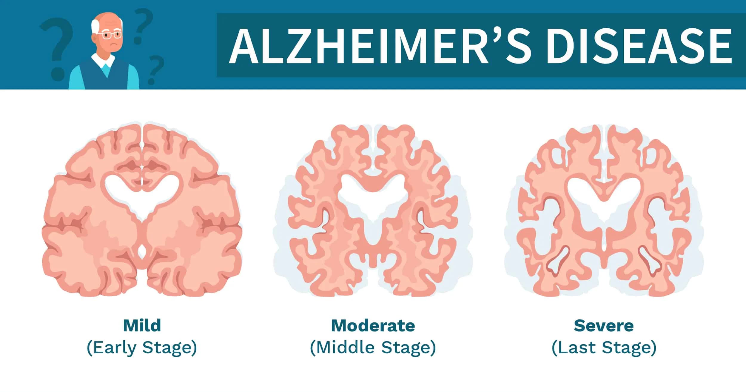 Understanding the Different Stages of Alzheimer’s Progression